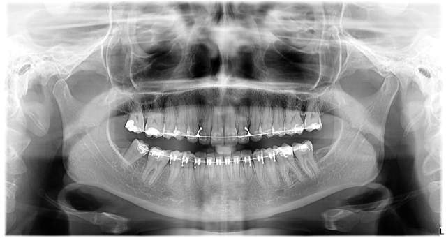 Orthodontic Treatment Process: Brackets, Orthodontic Appliances and More 2 hospitaprime xray