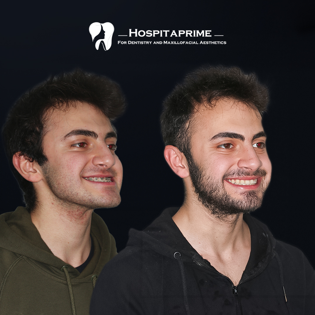 jaw surgery before after 11