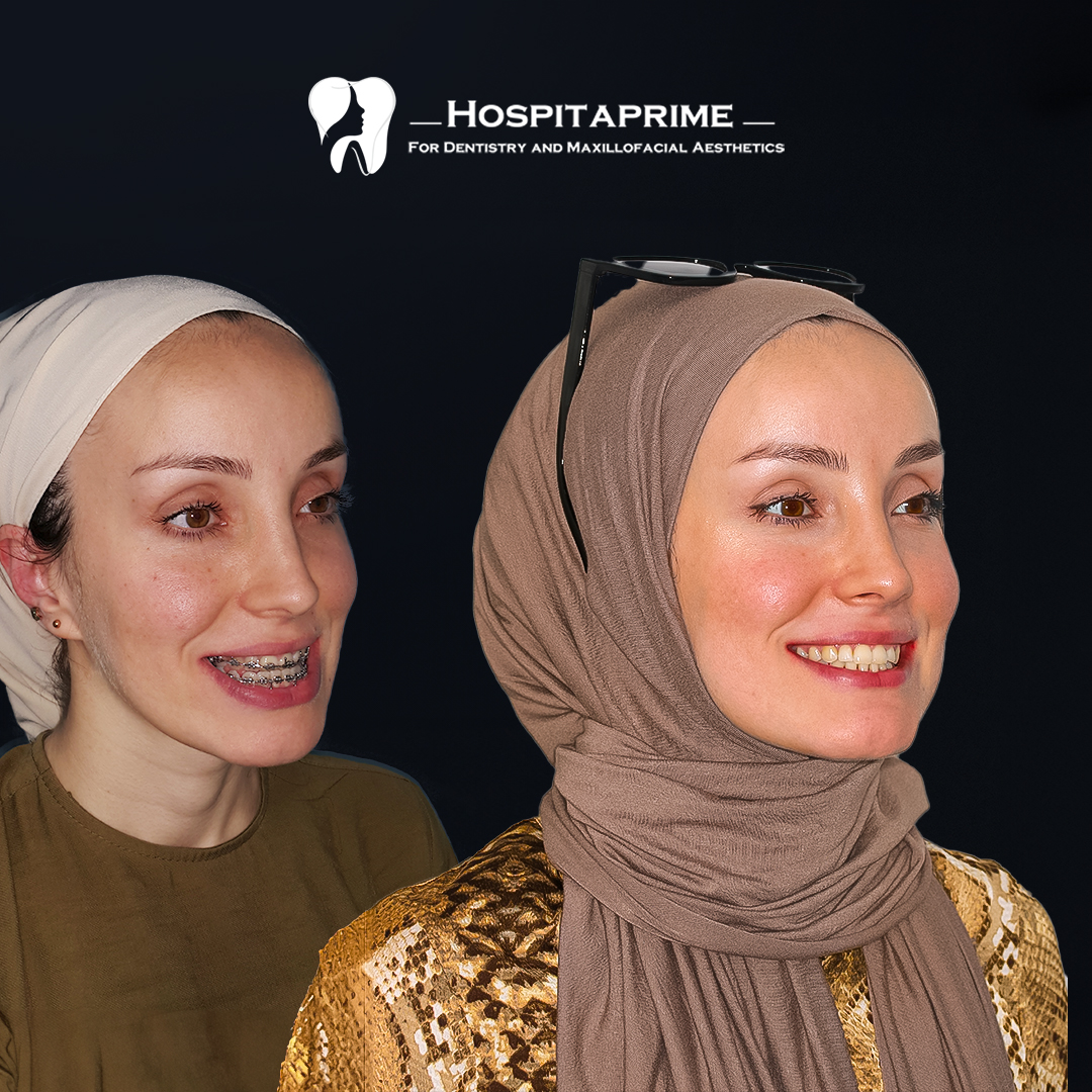 jaw surgery before after 12