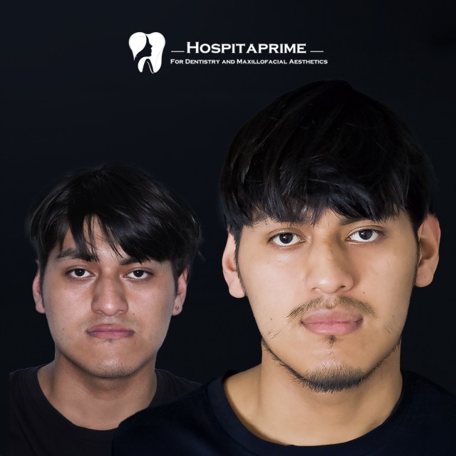 jaw surgery before after 13