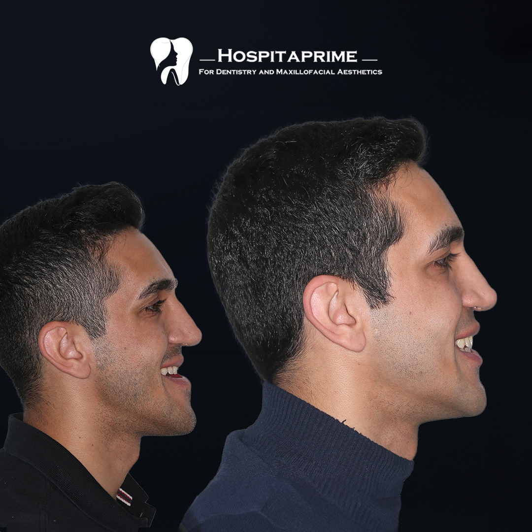 jaw surgery before after 14