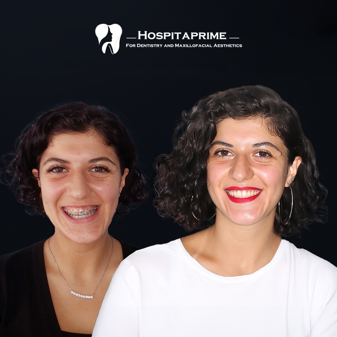 jaw surgery before after 15