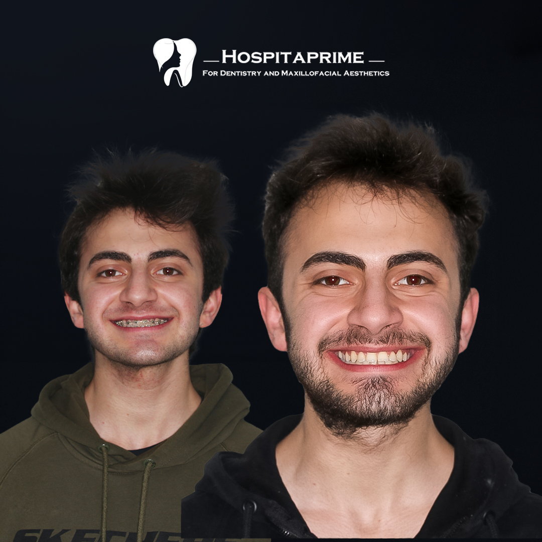 jaw surgery before after 16