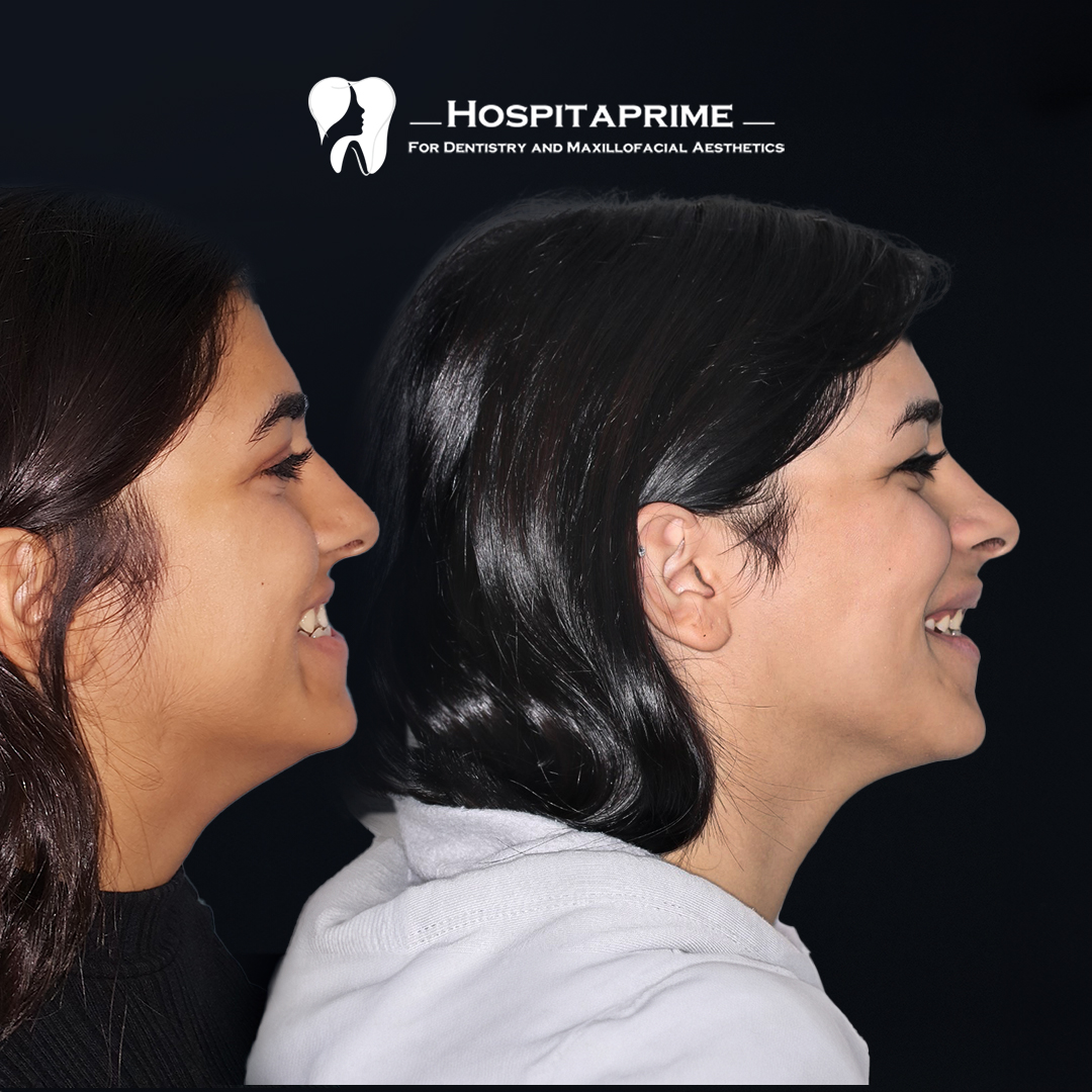 jaw surgery before after 4