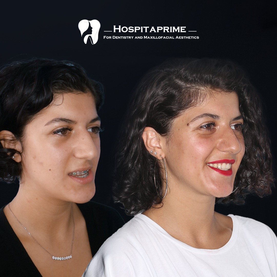 jaw surgery before after 5