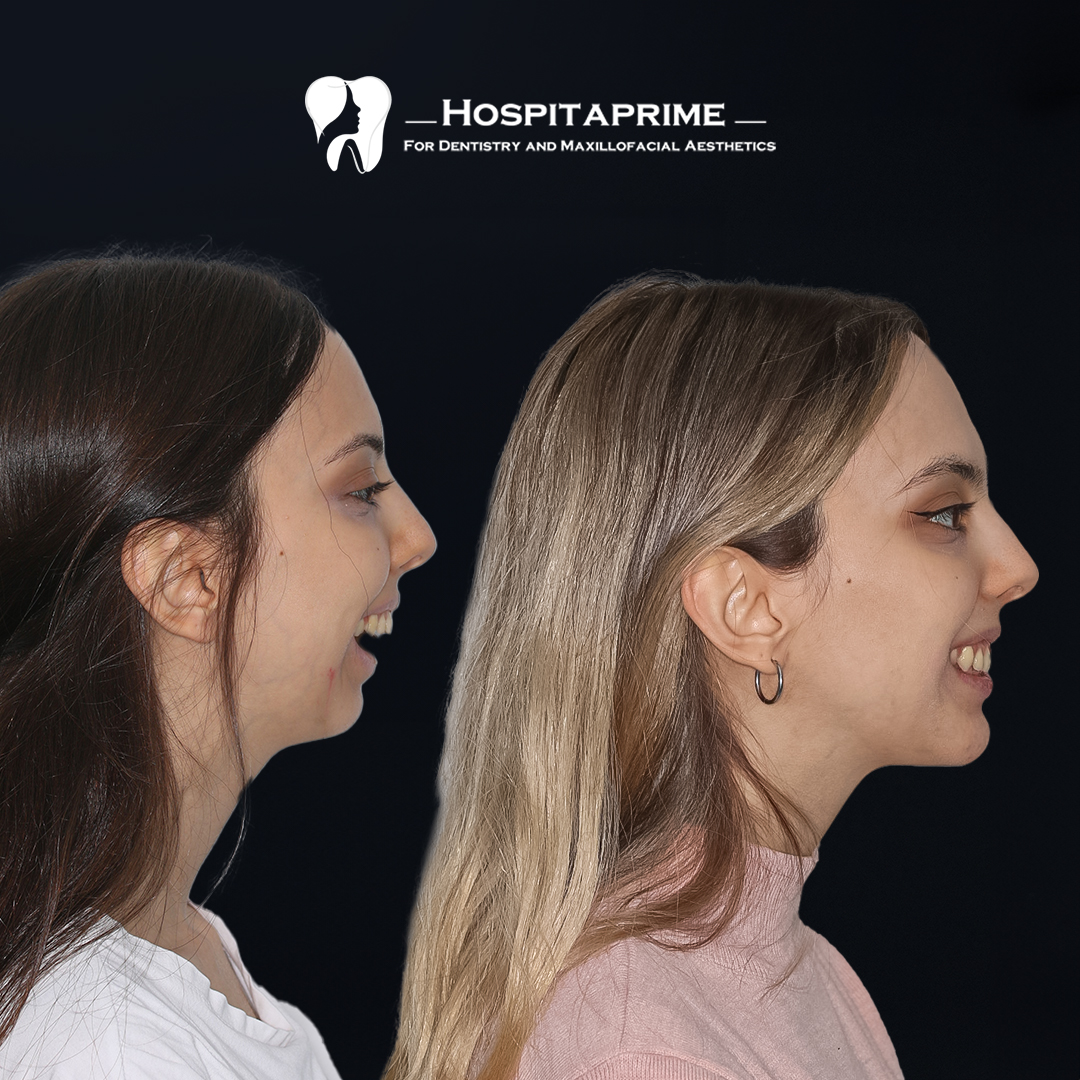 jaw surgery before after 6