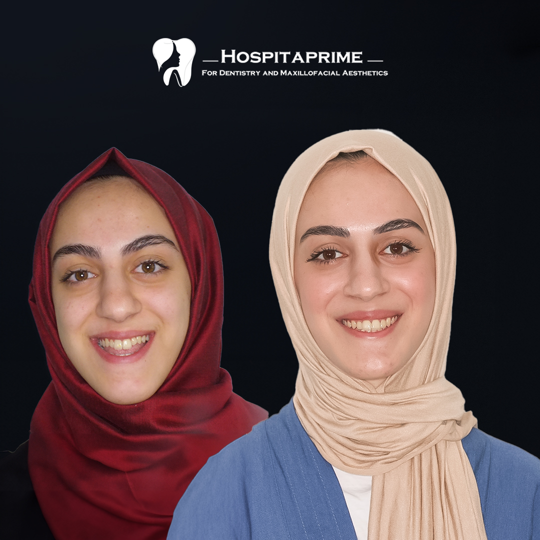 jaw surgery before after 7