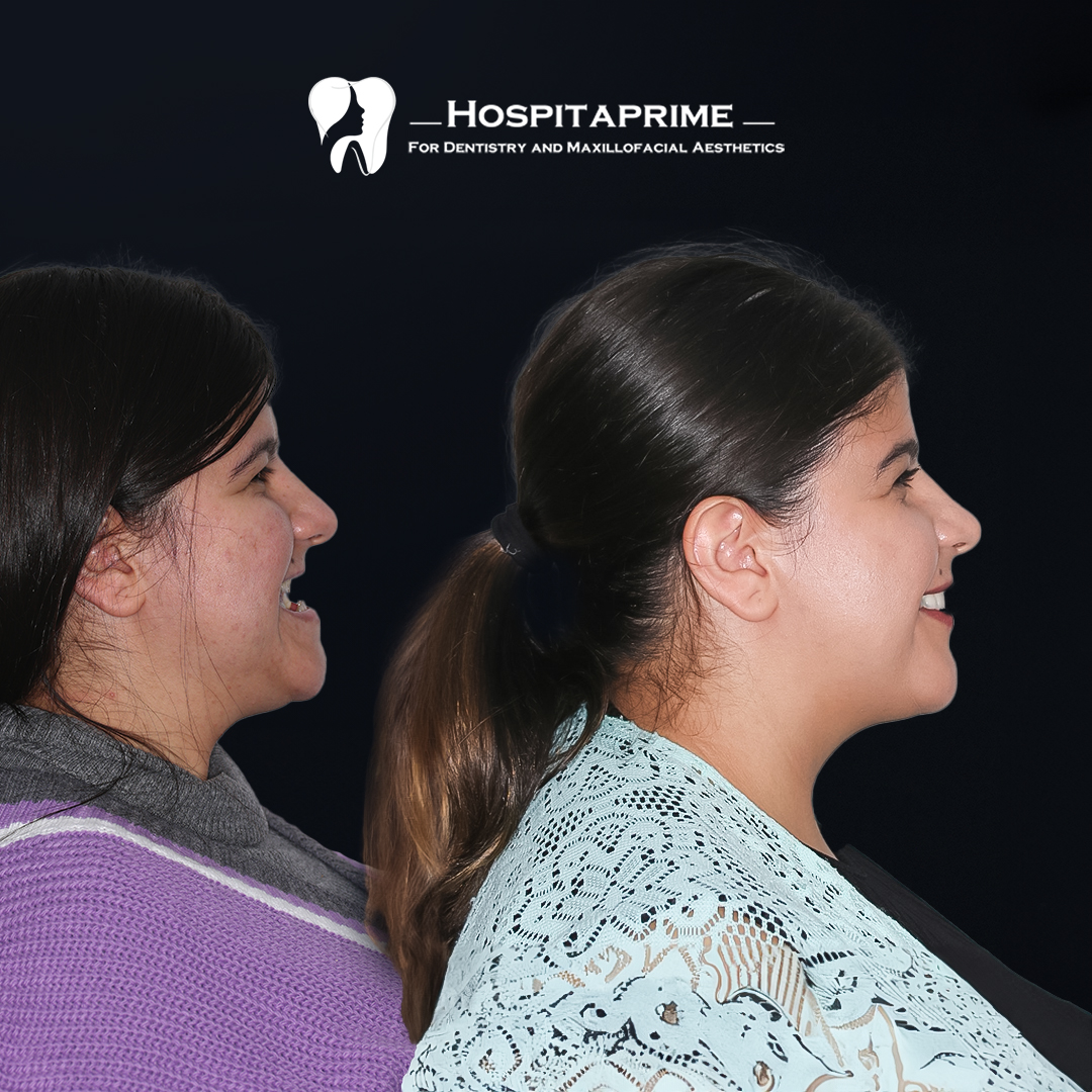 jaw surgery before after 9