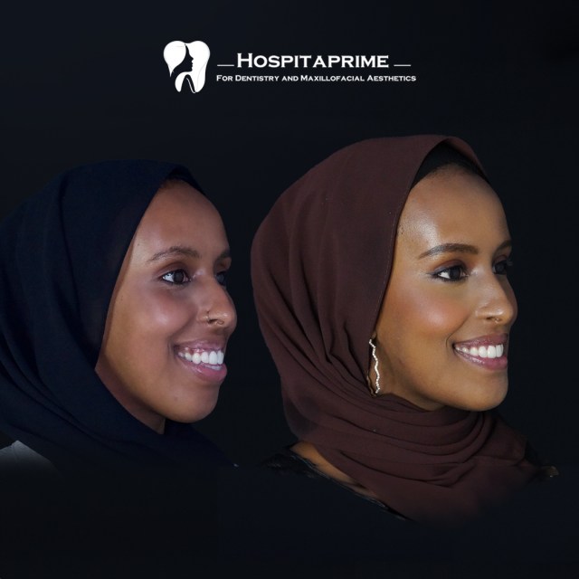 jaw surgery before after 19