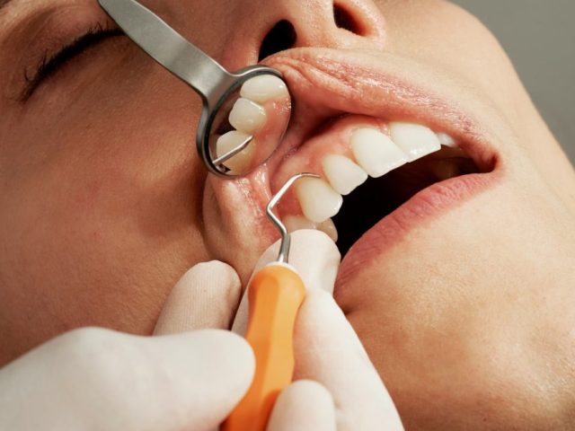 Diş Tartarı Nasıl Temizlenir?