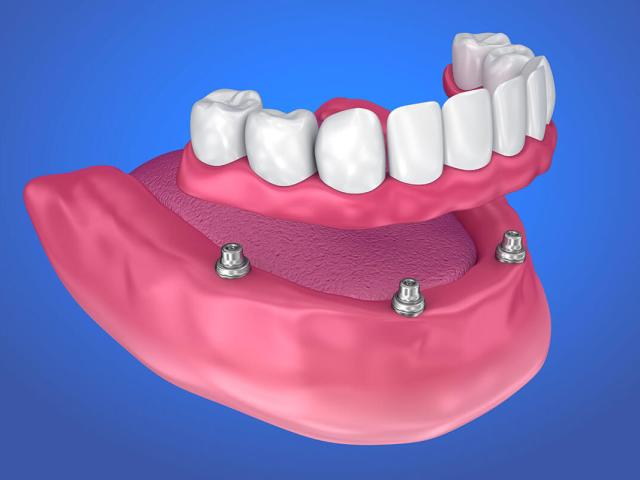 Can I Have a Dental Implant if I Use Dentures?