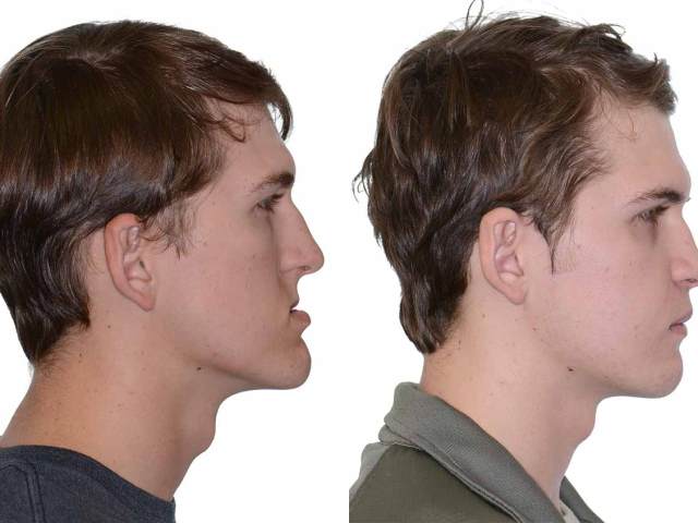10 Things I Wish I Knew Before Having Double Jaw Surgery