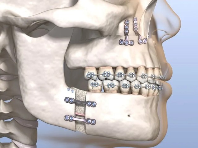 What to Expect During Recovery from Double Jaw Surgery?