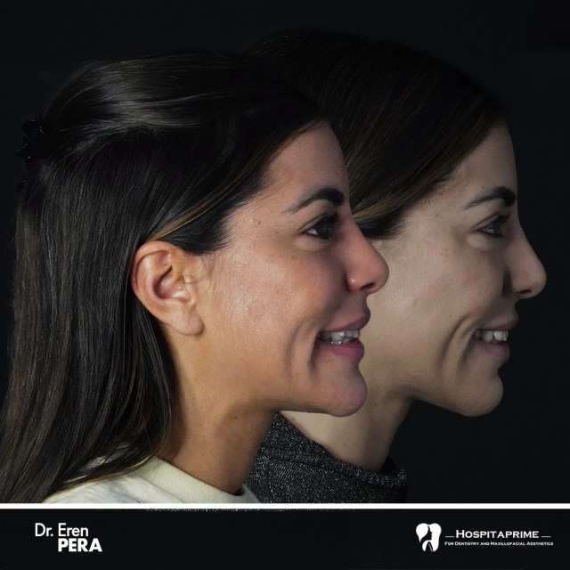 jaw surgery before after 82.2