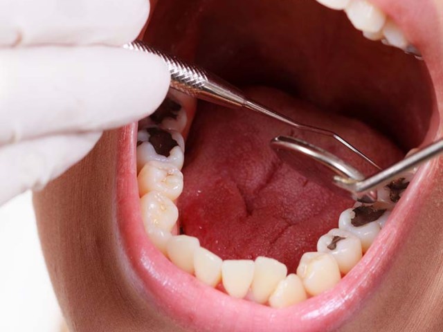 Çürük Diş Ağrısına Ne İyi Gelir?