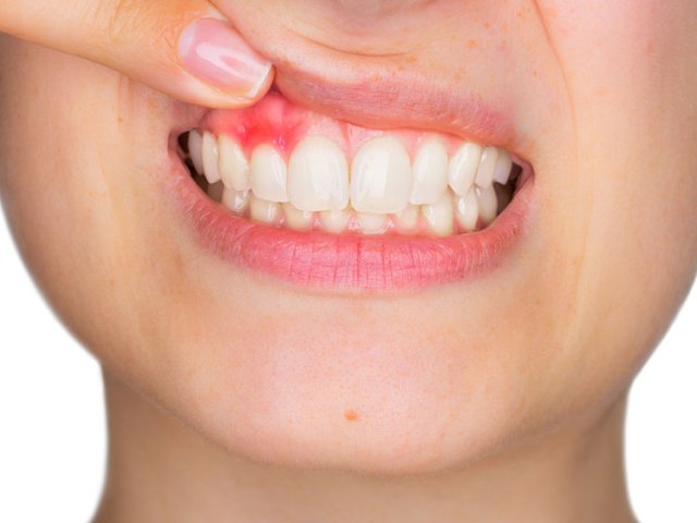 Dişte Lezyon Nedir? Diş Lezyonu Belirtileri