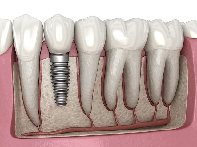 How Many Dental Implants Can Be Placed at Once?