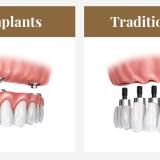 all on 4 implants vs traditional implants