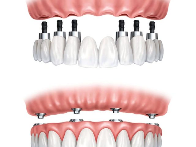 All-on-4 vs. Traditional Dental Implants