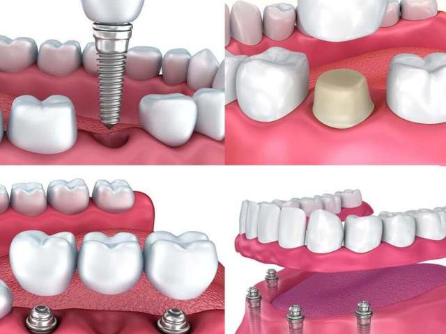 Dental Implant Restoration Options