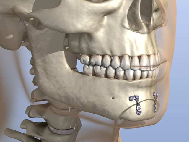 How Long Does It Take to Recover From Sliding Genioplasty?