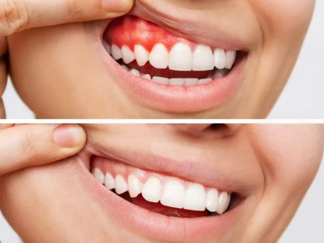 Understanding Severe Periodontal Disease: Causes, Treatment, and Prevention