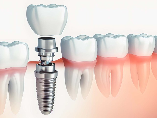 How to Perform Dental Implants for Severe Bone Resorption?