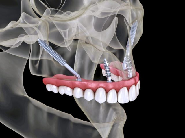 What Is Full Mouth Restoration with Zygoma Implants?