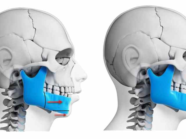 5 Things to Know About Jaw Joint Replacement Surgery