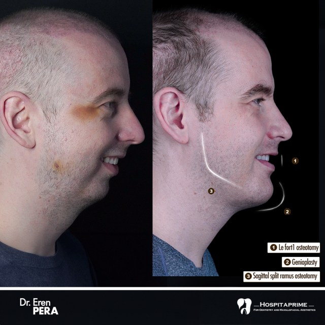 jaw surgery before after 101