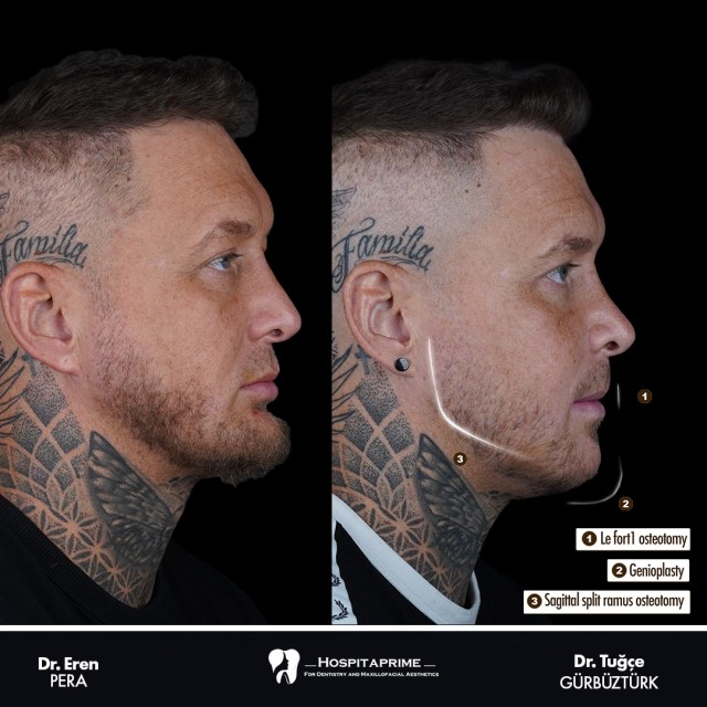 jaw surgery before after 128