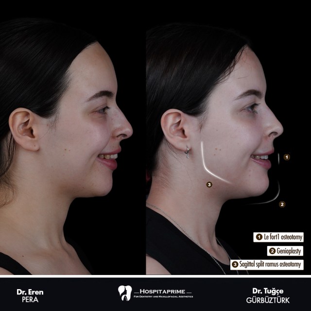 jaw surgery before after 130.2