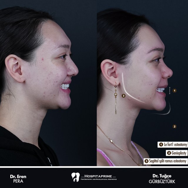 jaw surgery before after 151