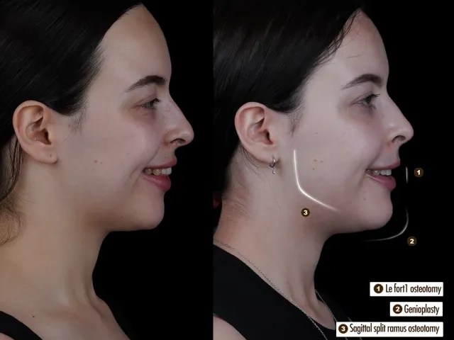 Jaw Surgery Before After Results