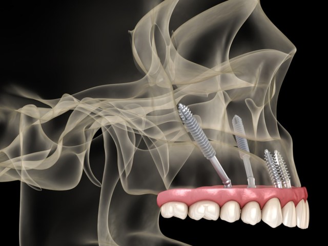 Zigoma Estetiği Sonrası Yüz Uyuşması Neden Olur?