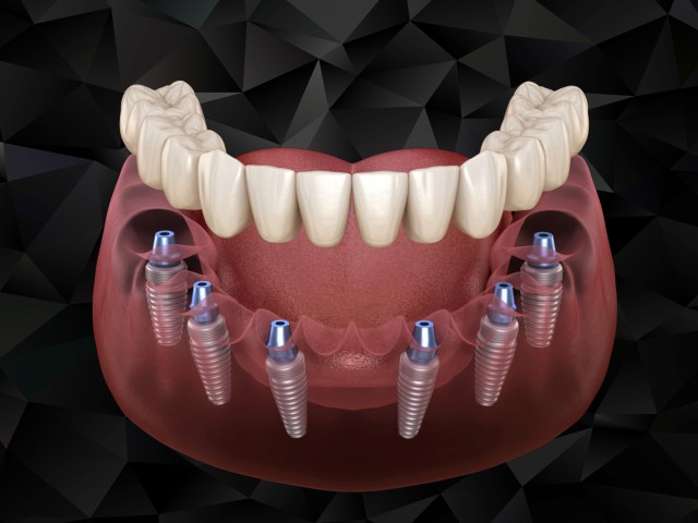 How Much Do All-on-6 Dental Implants Cost – 2026
