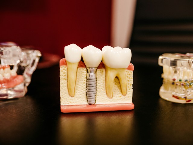 An In-Depth Guide to Obtaining Dental Implants in Turkey