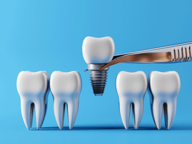 How Much Does Full Mouth Dental Implants Cost?