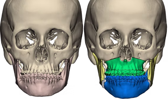 Custom Orthognathic Surgery – 2026