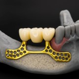 subperiosteal implant 2026