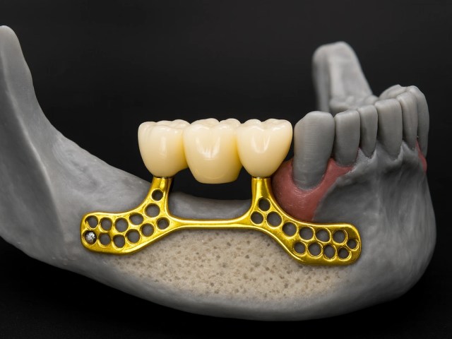 Implants Dentaires Sous-Périostés en Turquie & Istanbul – Prix, Avantages & Avis