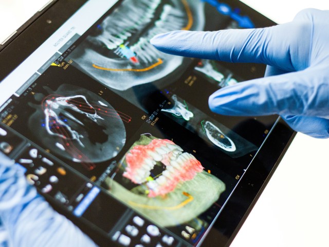 What Are Zygomatic Arch Implants? How to Perform?