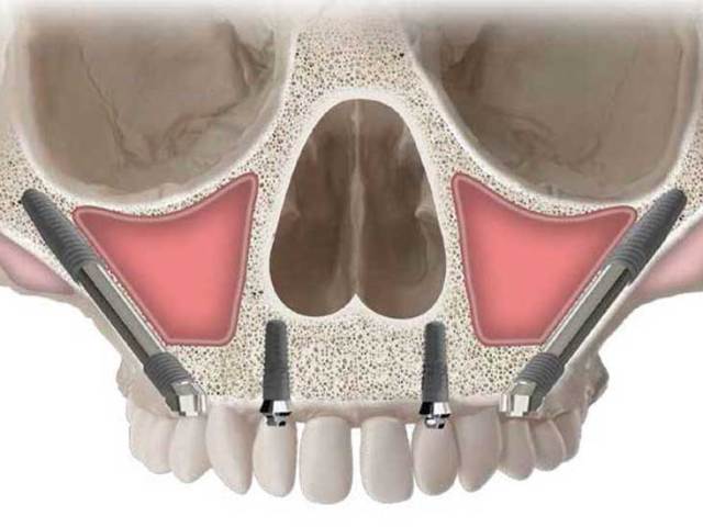 Çene Uyuşması Neden Olur? Nasıl Tedavi Edilir?