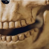 zygoma bone fracture