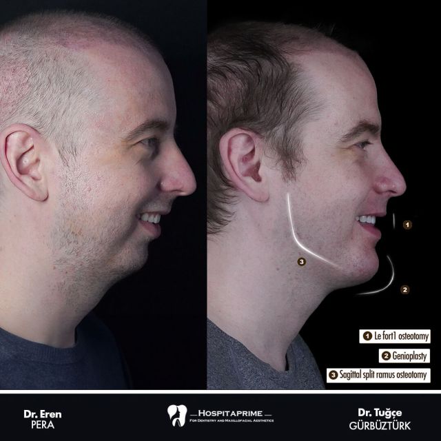 jaw-surgery-before-after-123-1