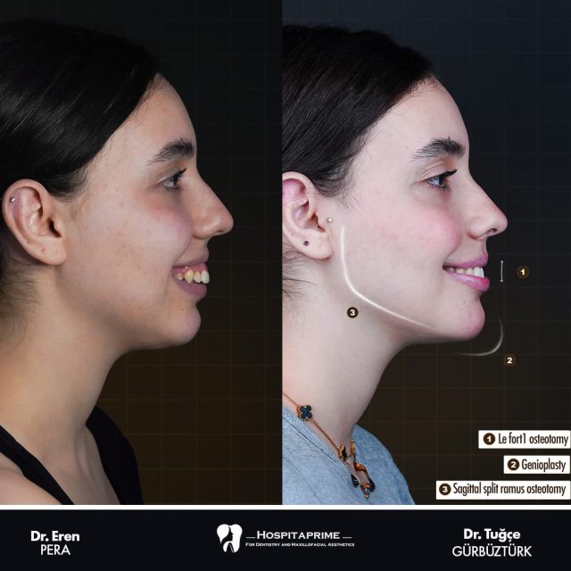 jaw-surgery-before-after-156.1-1
