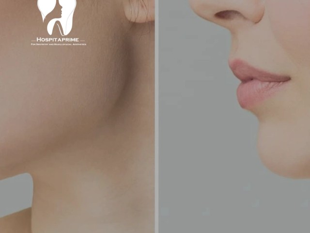 Does Jaw Surgery Change the Shape of Your Nose?